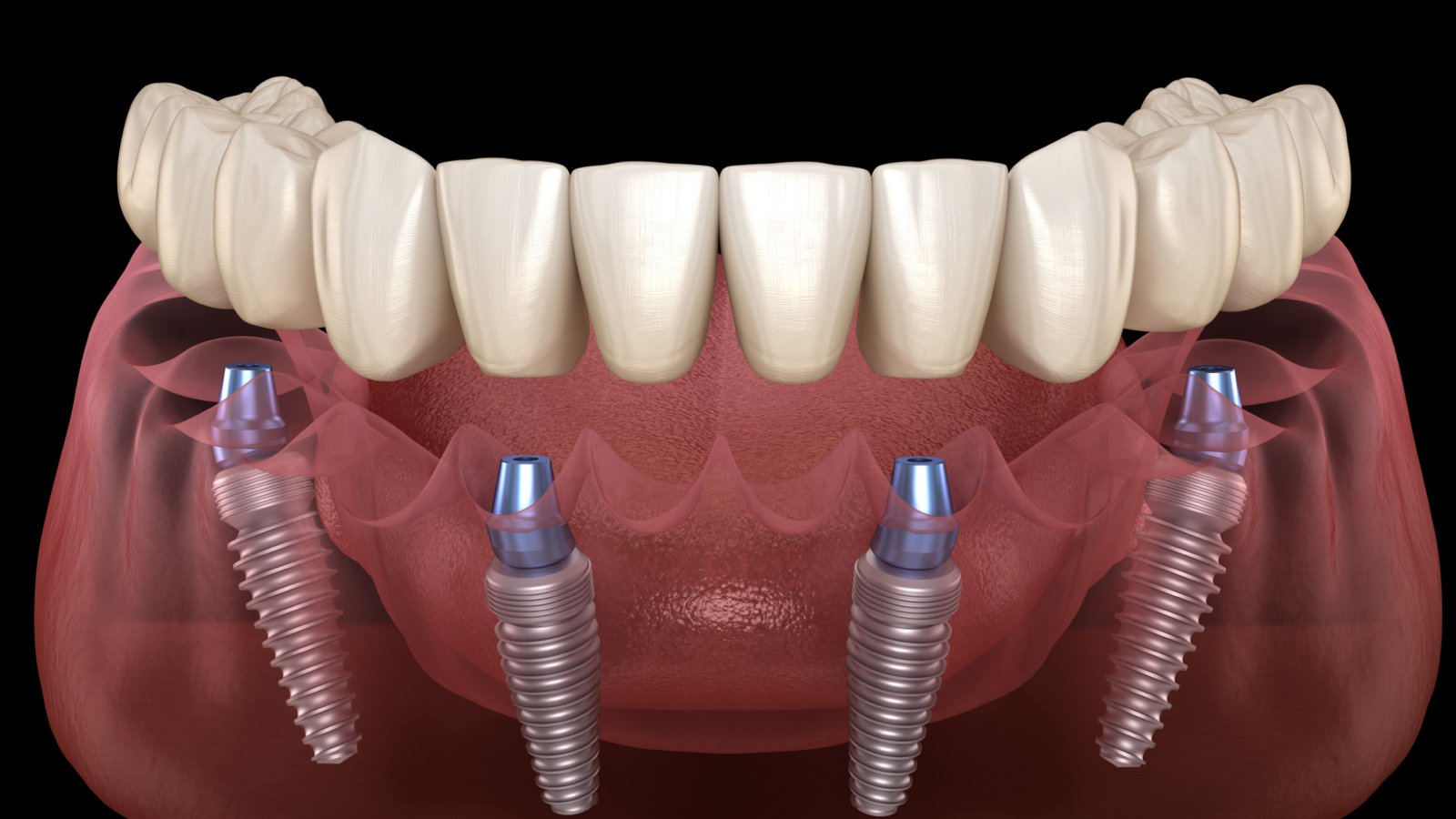 Illustration of All-on-4 dental implants in a jaw