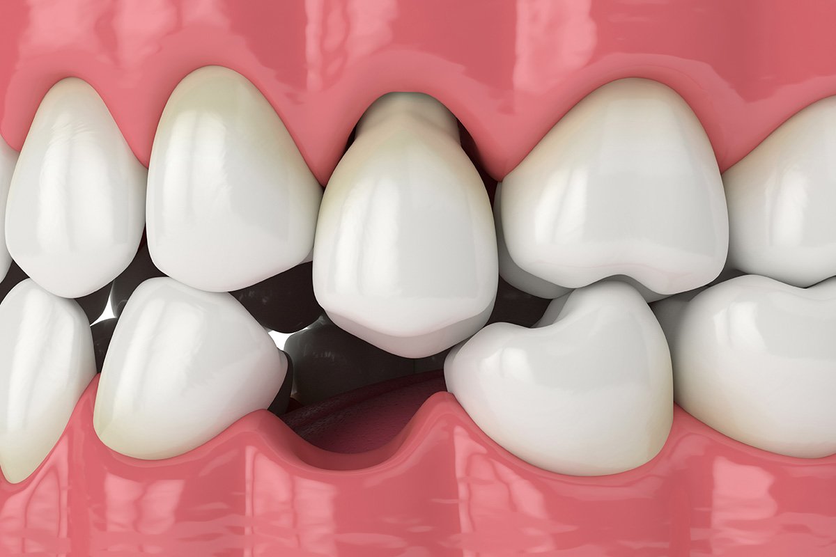 A smiling person with a complete set of teeth, showcasing dental restoration