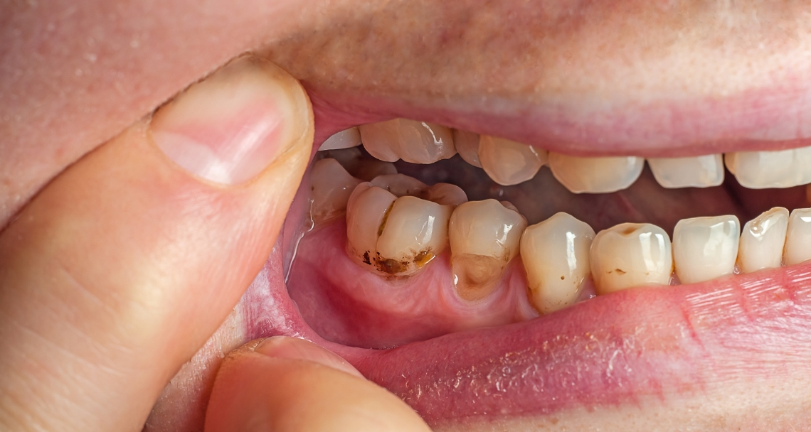 A person holding their jaw in pain, indicating a toothache