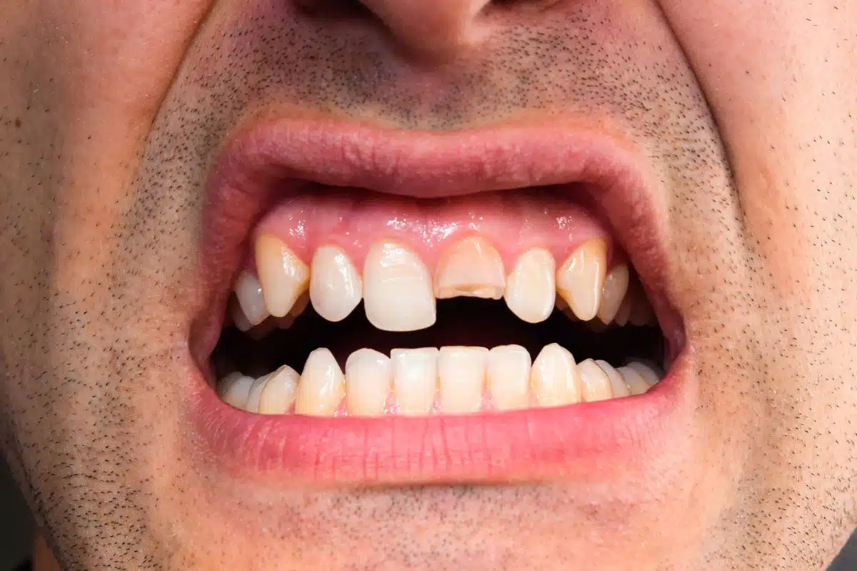 A person with a perfectly restored smile after a broken tooth treatment