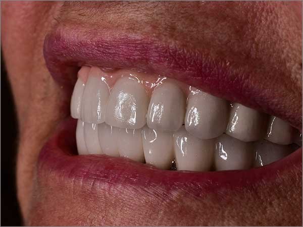 A person with a complete, beautiful smile after getting full mouth dental implants