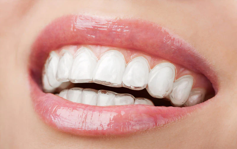 A person smiling confidently, showing clear Invisalign aligners
